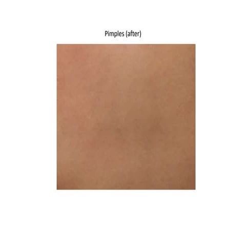 Pimple | PPTX