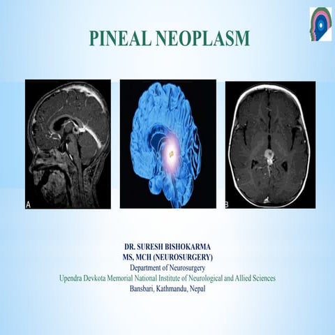 APPROACH TO PINEAL TUMOR