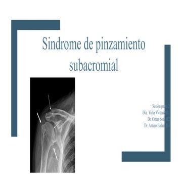 Pinzamiento subacromial