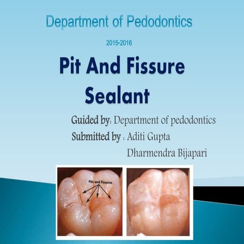 Pit and Fissure sealants