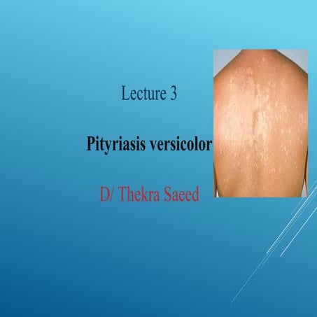 Pityriasis versicolor. For medical student | PPTX