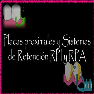 Placas proximales y Retenedores DPI...