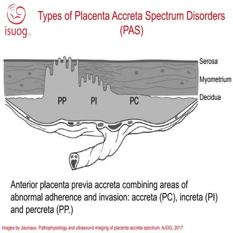 Placenta Accreta Spectrum imaging MRI.pptx