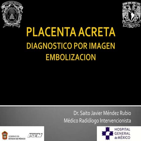 Placenta acreta