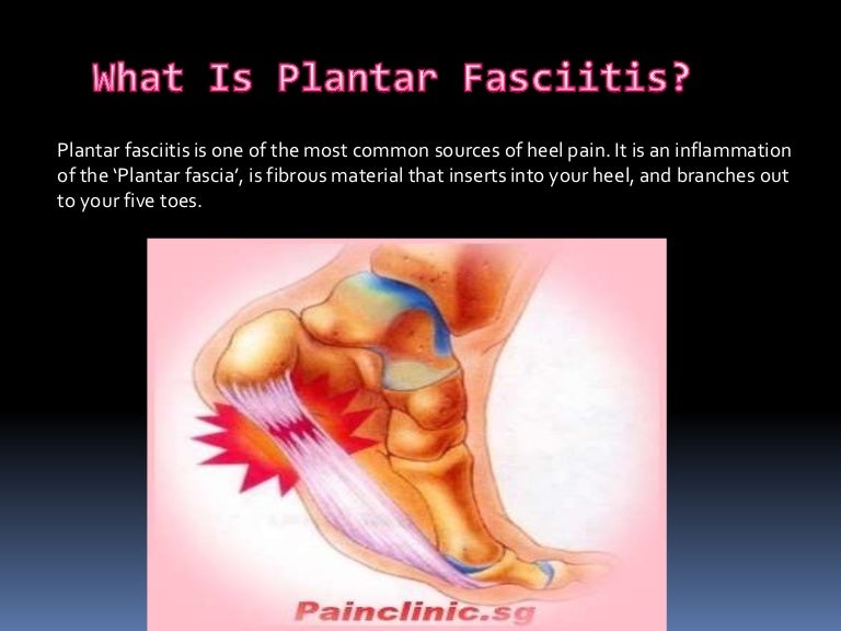 Plantar fasciitis causes, symptoms and treatments