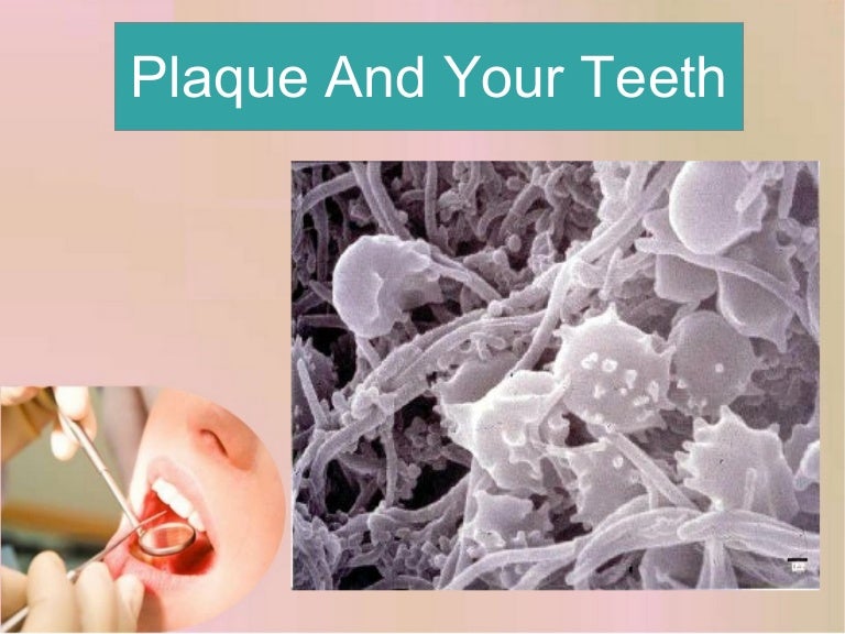 Plaque and your teeth