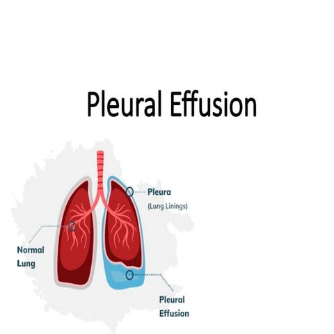 Pleural Effusion in respiratory examination-WPS Office.pptx
