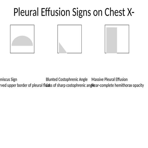 Identifying Pleural Effusion Signs on Chest X-Ray Imaging | PPTX