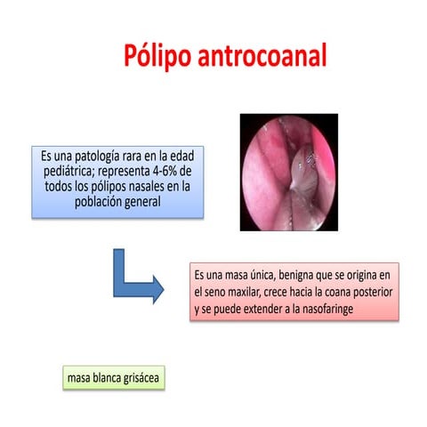 Pólipo antrocoanal.pptx