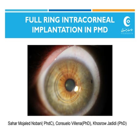 MyoRing in pellucid marginal degeneration | PPT