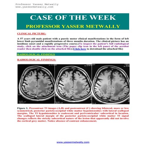 Progressive multifocal leukoencephalopathy