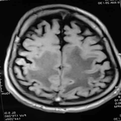 Progressive multifocal leukoencephalopathy