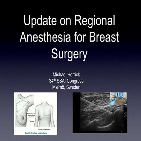 Update on regional anesthesia for breast surgery - Michael Herrick - SSAI2017