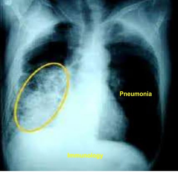 Pneumonia