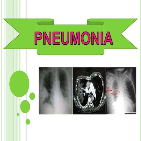 Pneumonia