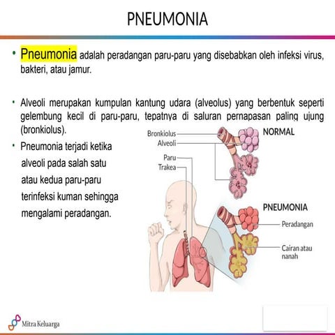 Comprehensive Overview of Pneumonia: Causes, Symptoms, Complications ...