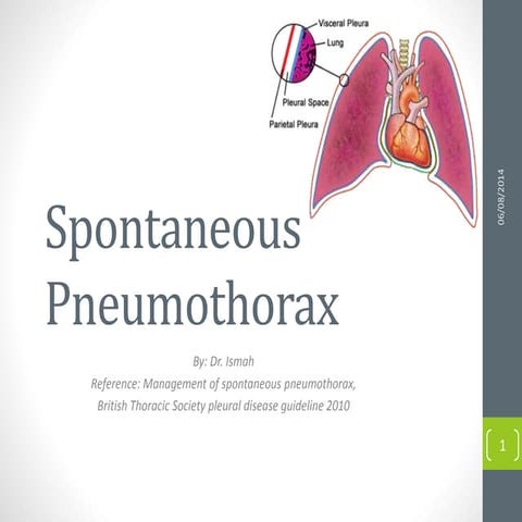Pneumothorax