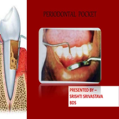 Periodontal Pockets