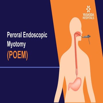 Peroral Endoscopic Myotomy (POEM) | Treatment For Achalasia of ...