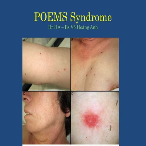(Dr HA) POEMS Syndrome - Hội chứng POEMS / Bs Võ Hoàng Anh | PPTX