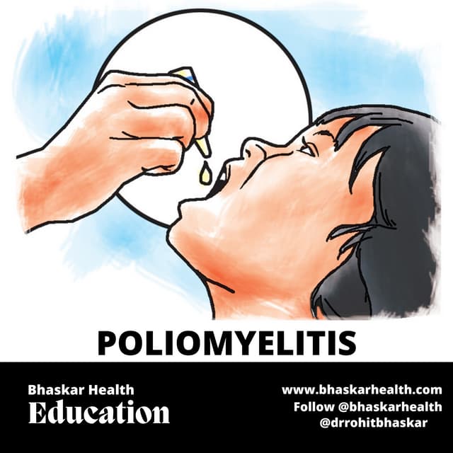 Polio (Poliomyelitis): Physiotherapy Treatment