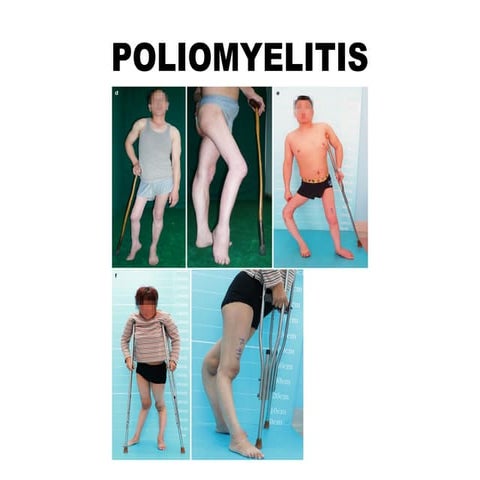 S.Y. G.N.M CHILD HEALTH NURSING-POLIOMYELITIS to FRACTURE.pptx