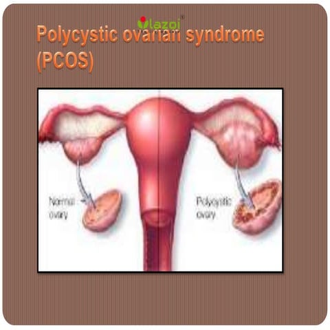 Polycystic ovarian syndrome (pcos)