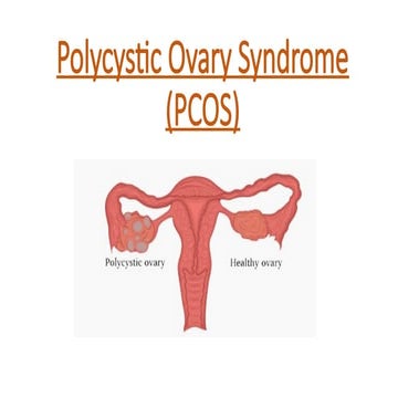 Polycystic Ovary Syndrome (PCOS) | PDF