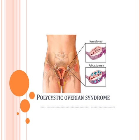 Polycystic overian syndrome