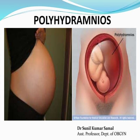 Polyhydramnios