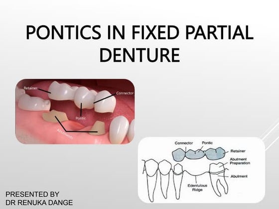 Pontics in Fixed Partial Denture | PPTX