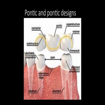 Pontic and pontic designs | PPTX