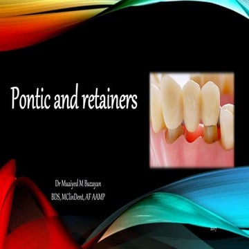 Pontics and retainers