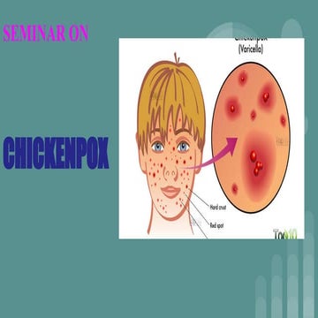 Chicken pox is a disease caused by the varicella zoster virus.it caused ...