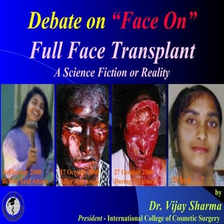 Full Face Transplant