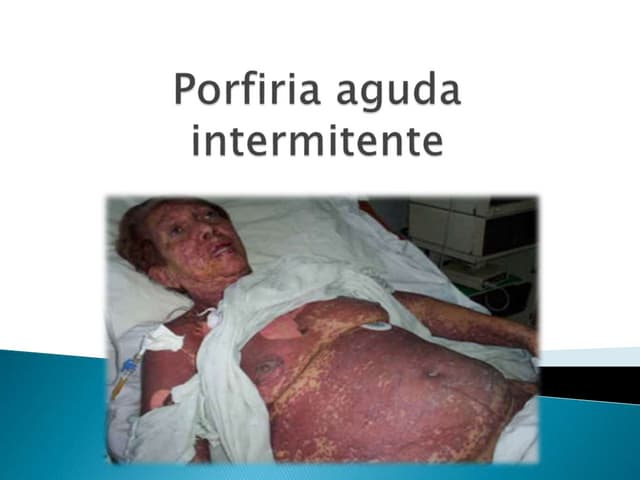 Porfiria aguda intermitente