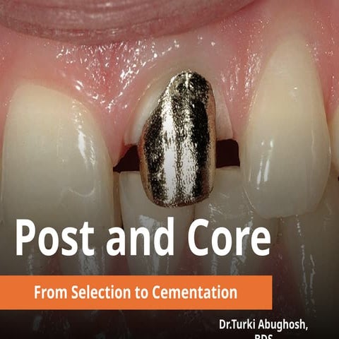 Post and Core presentation.pIN DENSITRYptx | PPTX