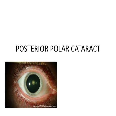 Posterior polar cataract