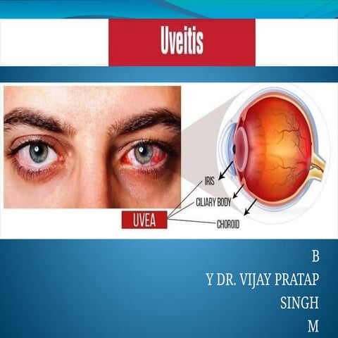 Approach to posterior uveitis final modified | PPTX