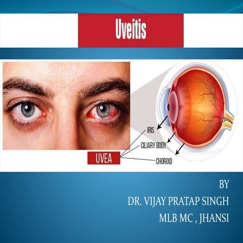 Posterior uveitis by Dr. VIJAY PRATAP VIPSY