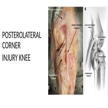 POSTEROLATERAL CORNER INJURY KNEE.pptx