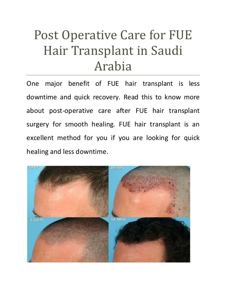Post Operative Care For Fue Hair Transplant Saudi Arabia