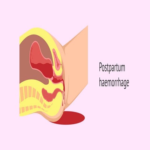 POST PARTUM HEMORRHAGE(PPH) | PPTX