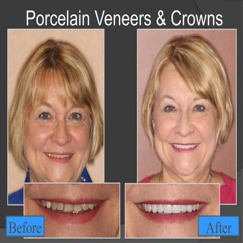 Dental Before and After photos