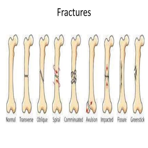 Types of Fractures | PPTX