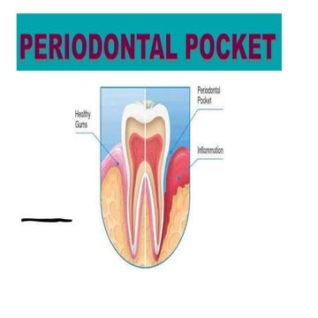 Periodontal pocket