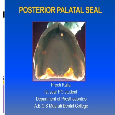 posterior palatal seal ppt