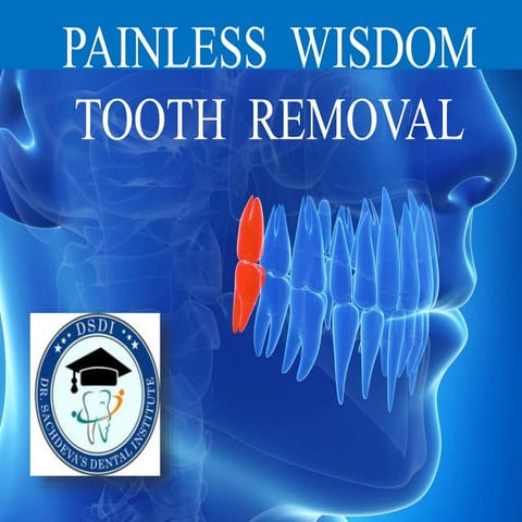 Painless Wisdom Tooth Removal| Impaction of Third Molar| Piezo and ...