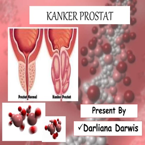 Ppt kanker prostat