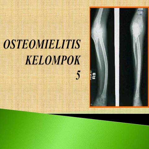 Ppt osteomielitis